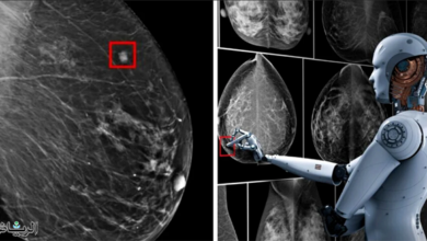 الذكاء الاصطناعي يساعد في تشخيص سرطان الثدي