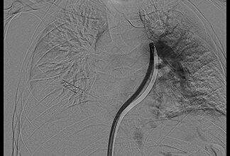 تقنية متقدمة تنقذ حياة مريض بمجمع الدمام الطبي